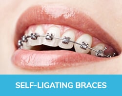 Self Ligating Braces