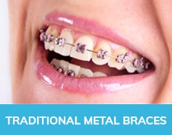 Traditional Metal Braces