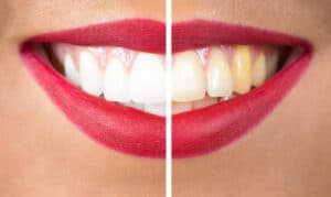 Prevent Yellowing Teeth and Maintain Oral Health
