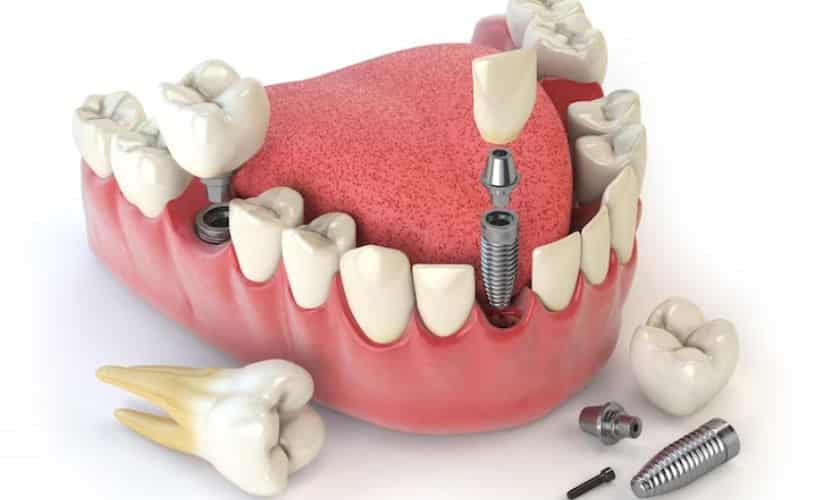 step-by-step dental implant process in jupiter - modern dental smiles