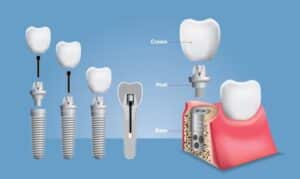 the truth about dental implants - modern dental smiles of jupiter
