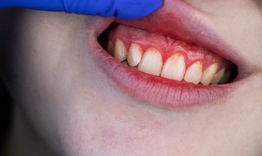 gum bleeding tips from a boynton beach emergency dentist