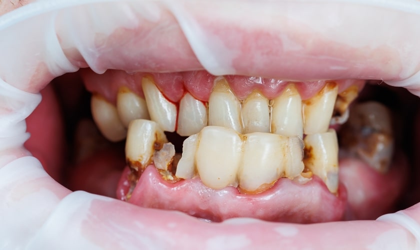 jupiter emergency dentist explains what the signs of serious gum disease are