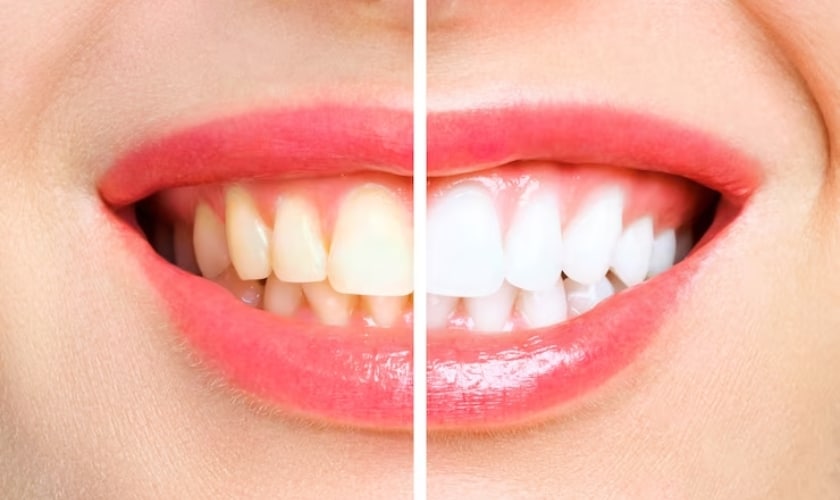 wellington dentists expert teeth whitening tips