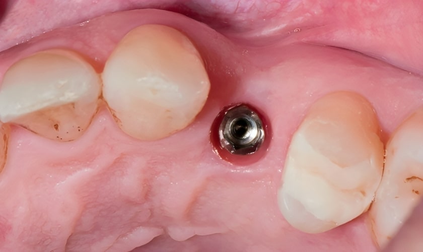 modern dental smiles of boynton beach dental implant dentist comprehensive guide on stages of full dental implants