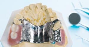 How Long Do You Need a Palatal Expander?