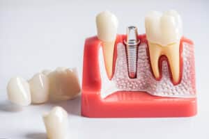 Dental Implants in