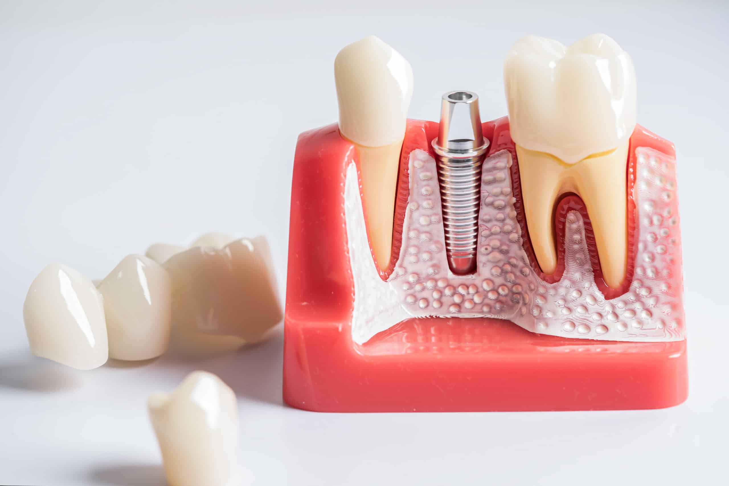 Dental Implants in